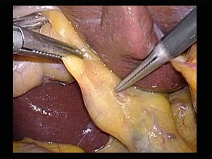 腹腔鏡下手術(外科)