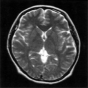 頭部MRI (脳の断面状態がよくわかります)