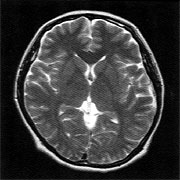 頭部MRI (脳の断面状態がよくわかります)