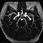頭部血管像MRA (脳の血管の状態がよくわかります)
